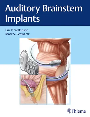 Auditorische Hirnstamm-Implantate - Auditory Brainstem Implants