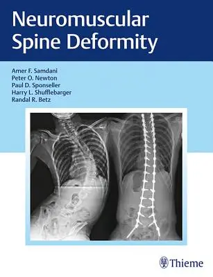 Neuromuskuläre Wirbelsäulendeformität - Neuromuscular Spine Deformity