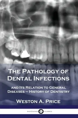 Die Pathologie der Zahninfektionen: und ihre Beziehung zu den allgemeinen Krankheiten - Geschichte der Zahnmedizin - The Pathology of Dental Infections: and Its Relation to General Diseases - History of Dentistry