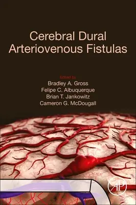 Zerebral-durale arteriovenöse Fisteln - Cerebral Dural Arteriovenous Fistulas