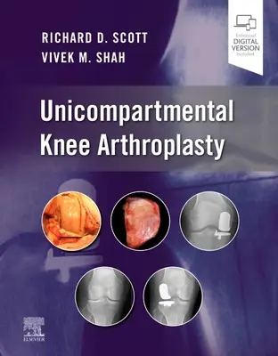 Unikompartimentelle Knieendoprothese - Unicompartmental Knee Arthroplasty
