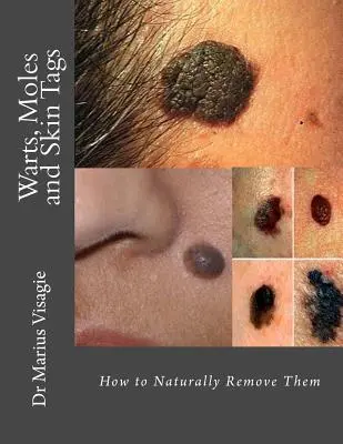 Warzen, Muttermale und Hautanhängsel: Wie man sie natürlich entfernt - Warts, Moles and Skin Tags: How to Naturally Remove Them