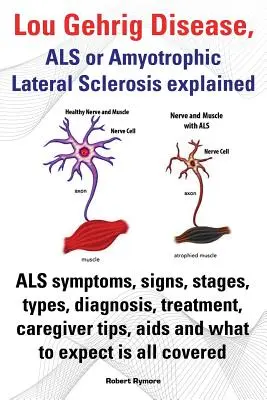 Lou-Gehrig-Krankheit, ALS oder Amyotrophe Lateralsklerose erklärt. ALS-Symptome, Anzeichen, Stadien, Arten, Diagnose, Behandlung, Tipps für Pfleger, AIDS und - Lou Gehrig Disease, ALS or Amyotrophic Lateral Sclerosis Explained. ALS Symptoms, Signs, Stages, Types, Diagnosis, Treatment, Caregiver Tips, AIDS and