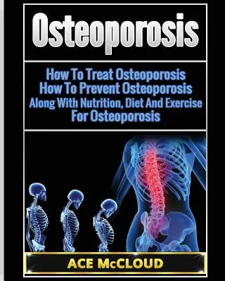Osteoporose: Wie Sie Osteoporose behandeln: Wie Sie Osteoporose vorbeugen: Zusammen mit Ernährung, Diät und Bewegung gegen Osteoporose - Osteoporosis: How To Treat Osteoporosis: How To Prevent Osteoporosis: Along With Nutrition, Diet And Exercise For Osteoporosis
