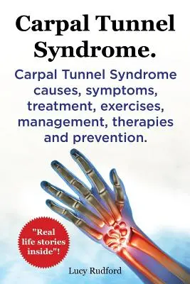 Karpaltunnelsyndrom, Cts. Karpaltunnelsyndrom Cts Ursachen, Symptome, Behandlung, Übungen, Management, Therapien und Prävention. - Carpal Tunnel Syndrome, Cts. Carpal Tunnel Syndrome Cts Causes, Symptoms, Treatment, Exercises, Management, Therapies and Prevention.