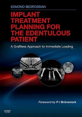 Implantat-Behandlungsplanung für den zahnlosen Patienten: Ein transplantatfreier Ansatz zur Sofortbelastung - Implant Treatment Planning for the Edentulous Patient: A Graftless Approach to Immediate Loading