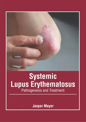 Systemischer Lupus erythematodes: Pathogenese und Behandlung - Systemic Lupus Erythematosus: Pathogenesis and Treatment
