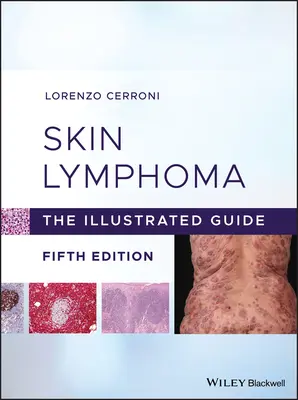 Haut-Lymphom: Der illustrierte Leitfaden - Skin Lymphoma: The Illustrated Guide