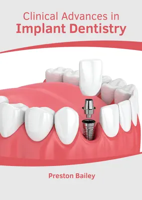 Klinische Fortschritte in der Implantologie - Clinical Advances in Implant Dentistry