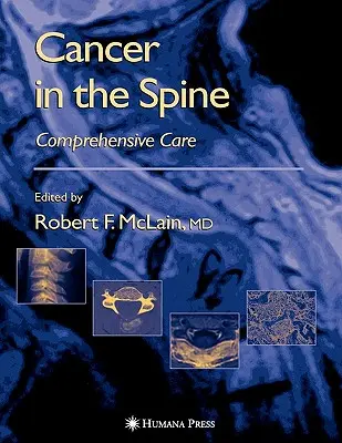 Krebs in der Wirbelsäule: Umfassende Behandlung - Cancer in the Spine: Comprehensive Care