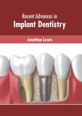 Jüngste Fortschritte in der Implantat-Zahnmedizin - Recent Advances in Implant Dentistry