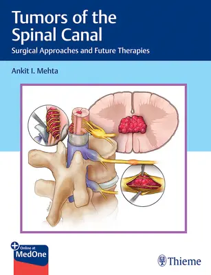 Tumore des Spinalkanals: Chirurgische Ansätze und zukünftige Therapien - Tumors of the Spinal Canal: Surgical Approaches and Future Therapies