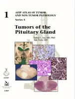Tumore der Hirnanhangsdrüse - Tumors of the Pituitary Gland