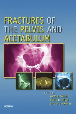 Frakturen des Beckens und der Hüftgelenkspfanne - Fractures of the Pelvis and Acetabulum