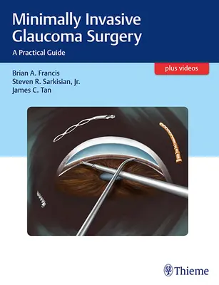 Minimalinvasive Glaukomchirurgie: Ein praktischer Leitfaden - Minimally Invasive Glaucoma Surgery: A Practical Guide