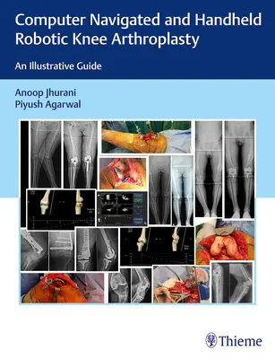 Computernavigierte und handgeführte robotergestützte Knieendoprothetik: Ein illustrativer Leitfaden - Computer Navigated and Handheld Robotic Knee Arthroplasty: An Illustrative Guide