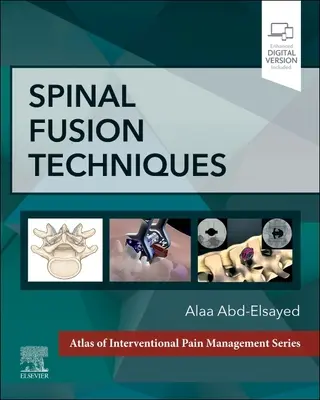 Techniken der Wirbelsäulenfusion - Spinal Fusion Techniques