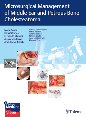 Mikrochirurgische Behandlung von Mittelohr- und Felsenbein-Cholesteatomen - Microsurgical Management of Middle Ear and Petrous Bone Cholesteatoma