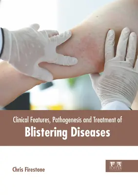 Klinische Merkmale, Pathogenese und Behandlung von Blasenkrankheiten - Clinical Features, Pathogenesis and Treatment of Blistering Diseases