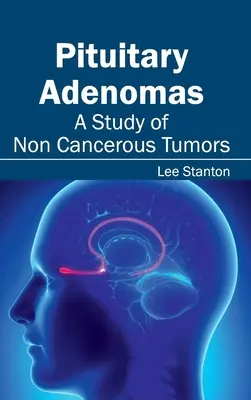 Hypophysäre Adenome: Eine Studie über nicht krebsartige Tumore - Pituitary Adenomas: A Study of Non Cancerous Tumors