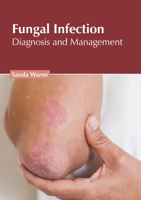 Pilzinfektion: Diagnose und Management - Fungal Infection: Diagnosis and Management