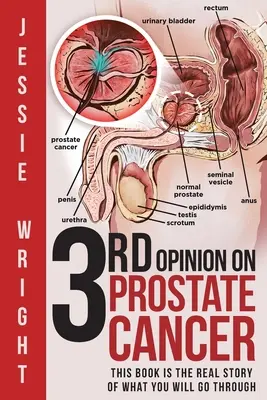 3. Meinung zu Prostatakrebs - 3rd Opinion on Prostate Cancer