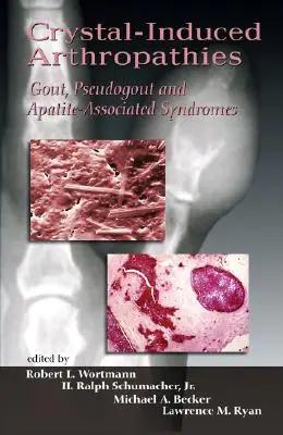 Kristallinduzierte Arthropathien: Gicht, Pseudogicht und Apatit-assoziierte Syndrome - Crystal-Induced Arthropathies: Gout, Pseudogout and Apatite-Associated Syndromes