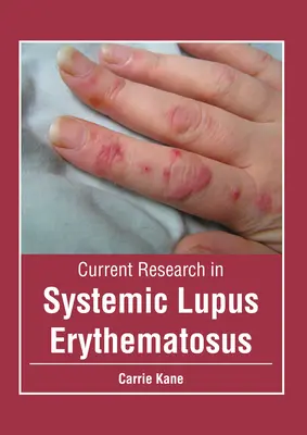 Aktuelle Forschung zum systemischen Lupus erythematodes - Current Research in Systemic Lupus Erythematosus