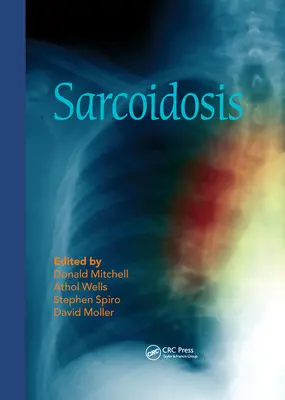 Sarkoidose - Sarcoidosis