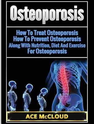 Osteoporose: Wie Sie Osteoporose behandeln: Wie Sie Osteoporose vorbeugen: Mit Ernährung, Diät und Bewegung gegen Osteoporose - Osteoporosis: How To Treat Osteoporosis: How To Prevent Osteoporosis: Along With Nutrition, Diet And Exercise For Osteoporosis