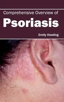 Umfassender Überblick über Psoriasis - Comprehensive Overview of Psoriasis