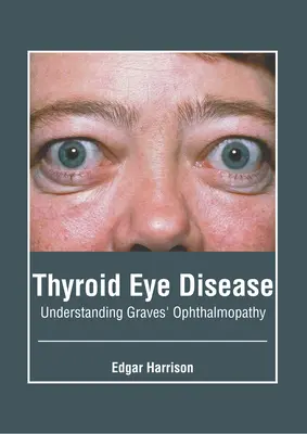 Schilddrüsen-Augenkrankheit: Die Graves'sche Ophthalmopathie verstehen - Thyroid Eye Disease: Understanding Graves' Ophthalmopathy