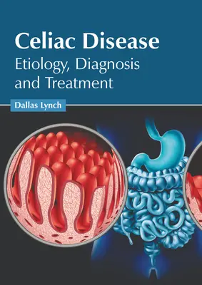 Zöliakie: Ätiologie, Diagnose und Behandlung - Celiac Disease: Etiology, Diagnosis and Treatment