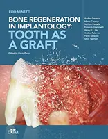 Knochenregeneration in der Implantologie - der Zahn als Transplantat - Bone regeneration in implantology - tooth as a graft