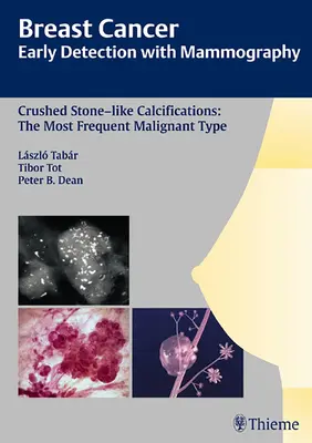 Breast Cancer: Früherkennung mit Mammographie: Crushed Stone-Like Calcifications: Die häufigste bösartige Form [mit CDROM] - Breast Cancer: Early Detection with Mammography: Crushed Stone-Like Calcifications: The Most Frequent Malignant Type [With CDROM]