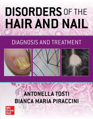 Erkrankungen der Haare und Nägel: Diagnose und Behandlung - Disorders of the Hair and Nail: Diagnosis and Treatment