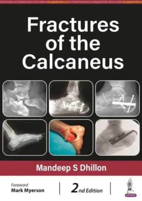 Frakturen des Fersenbeins - Fractures of the Calcaneus